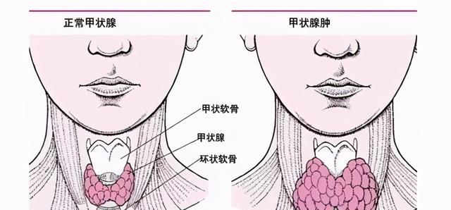 一个动作自测甲状腺疾病