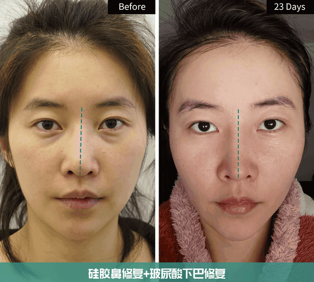 30岁姑娘鼻子+下巴修复，术后即刻到23天实拍，自然如“妈生”