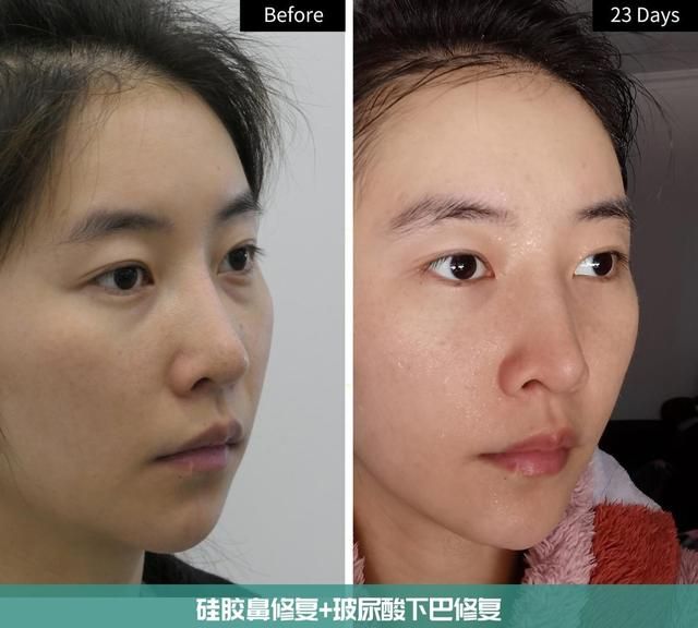 30岁姑娘鼻子+下巴修复，术后即刻到23天实拍，自然如“妈生”