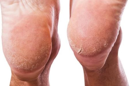 脚后跟干裂怎么办最有效的办法,脚后跟干裂怎么办最快的方法