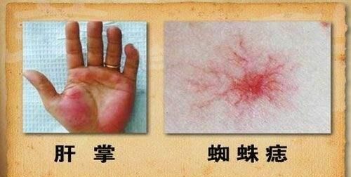 肝不好的人会有哪些症状图10