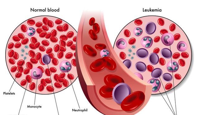 为什么越来越多人患上白血病？5个原因或是“祸根”，要防着点