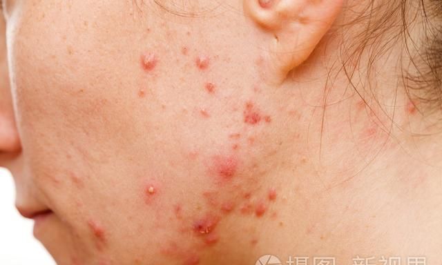 痤疮是很常见的疾病，痤疮的治疗方法有什么？