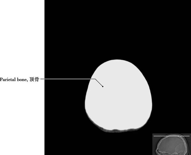 详细标注版——颅脑CT正常解剖图谱