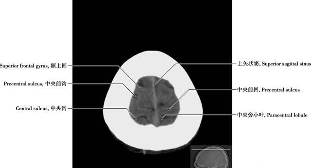 详细标注版——颅脑CT正常解剖图谱