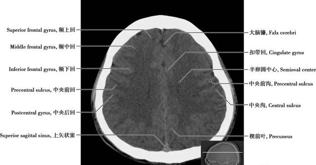 详细标注版——颅脑CT正常解剖图谱