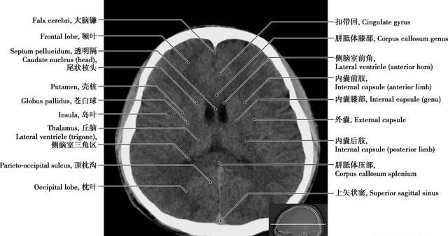 详细标注版——颅脑CT正常解剖图谱