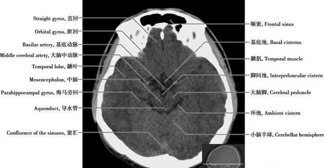 详细标注版——颅脑CT正常解剖图谱