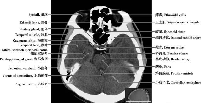 详细标注版——颅脑CT正常解剖图谱