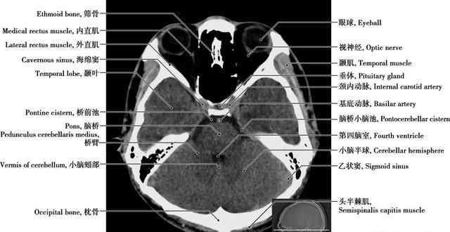 详细标注版——颅脑CT正常解剖图谱