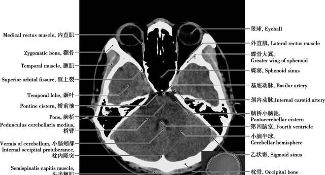 详细标注版——颅脑CT正常解剖图谱