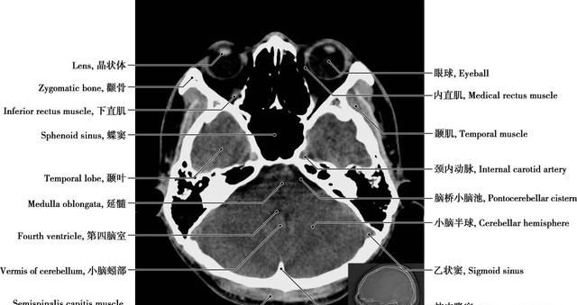 详细标注版——颅脑CT正常解剖图谱