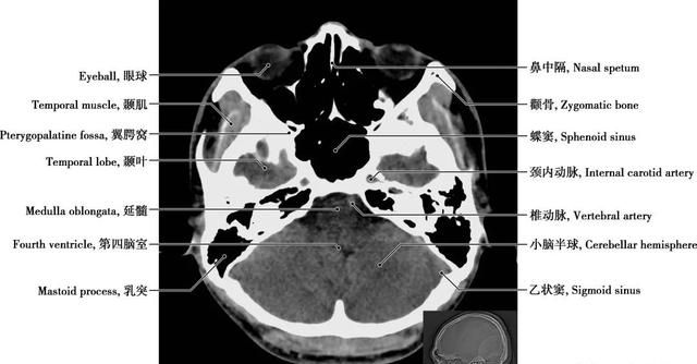 详细标注版——颅脑CT正常解剖图谱