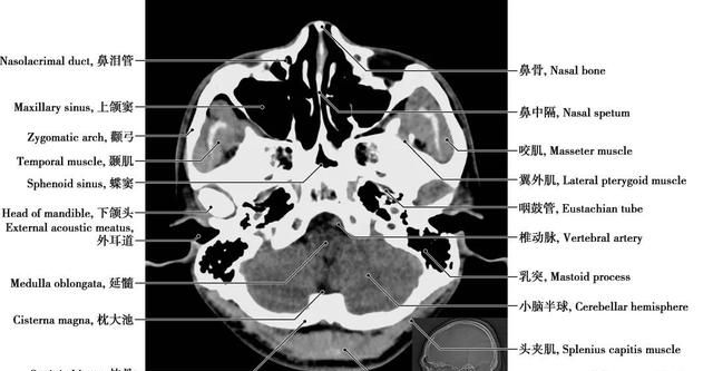 详细标注版——颅脑CT正常解剖图谱