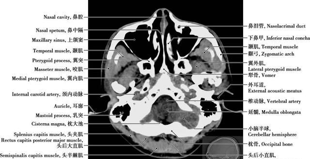 详细标注版——颅脑CT正常解剖图谱