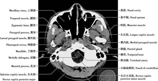 详细标注版——颅脑CT正常解剖图谱