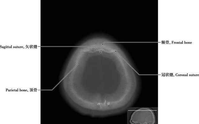 详细标注版——颅脑CT正常解剖图谱