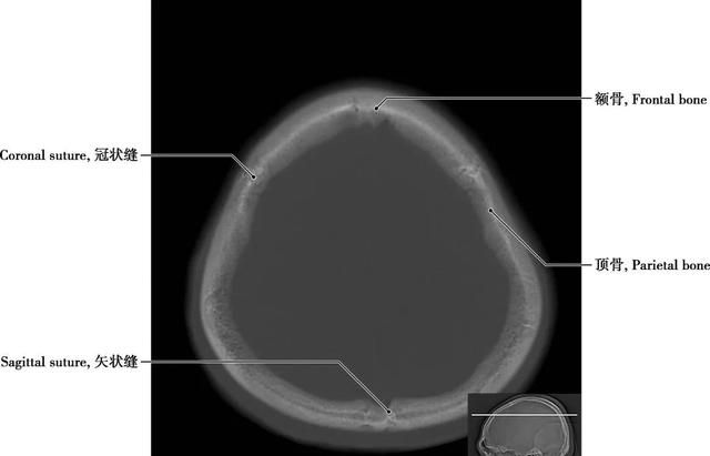详细标注版——颅脑CT正常解剖图谱