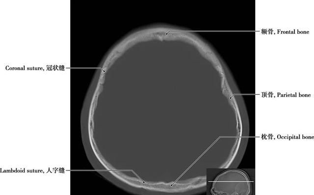 详细标注版——颅脑CT正常解剖图谱