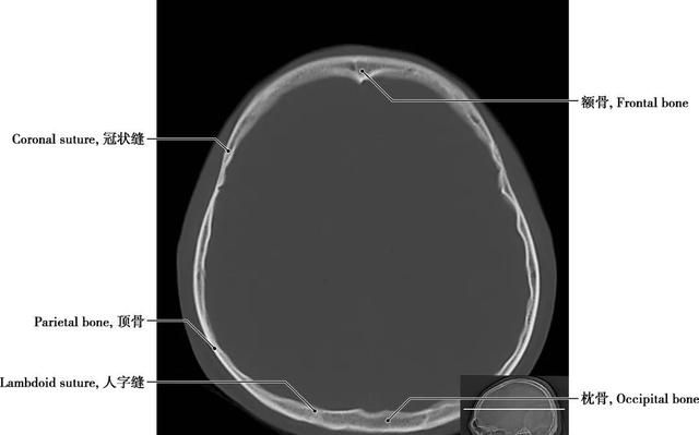 详细标注版——颅脑CT正常解剖图谱