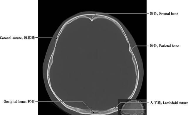 详细标注版——颅脑CT正常解剖图谱