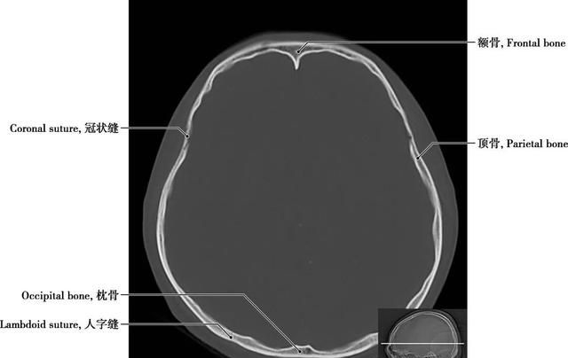详细标注版——颅脑CT正常解剖图谱