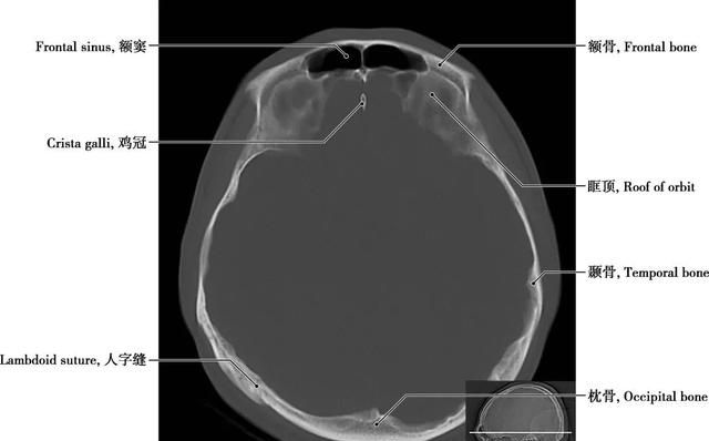 详细标注版——颅脑CT正常解剖图谱