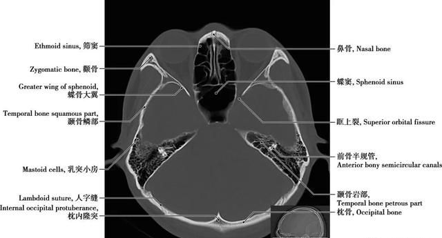 详细标注版——颅脑CT正常解剖图谱