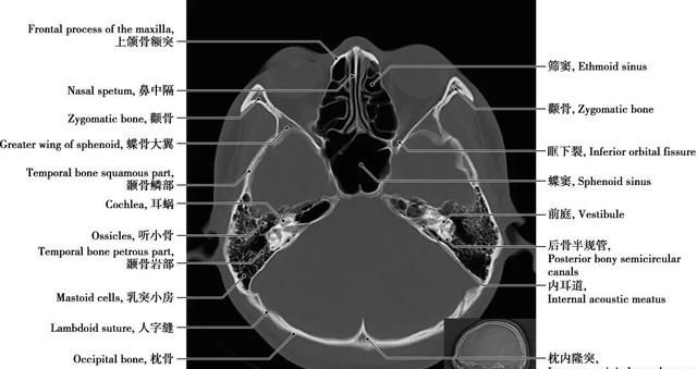 详细标注版——颅脑CT正常解剖图谱