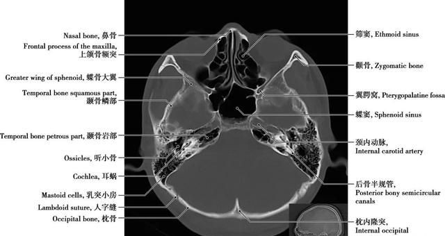 详细标注版——颅脑CT正常解剖图谱