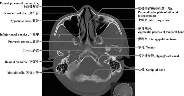 详细标注版——颅脑CT正常解剖图谱