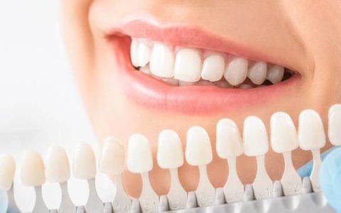 牙齿贴面效果好吗,牙齿贴面效果好不好