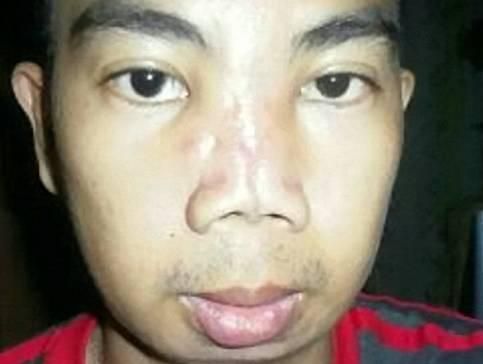 整容只花65块？菲律宾16岁男模亲测史上最低价整容
