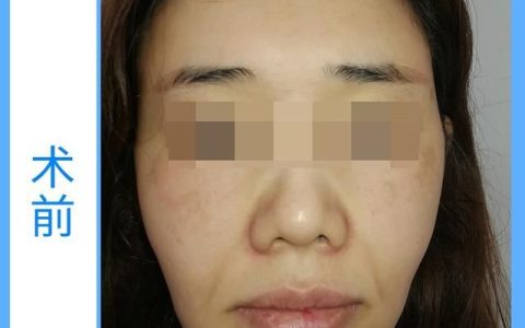 做拉皮的真实感受,现在还有做拉皮的吗