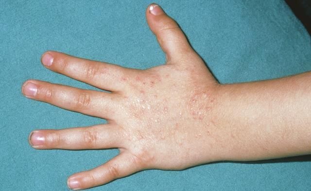 熟知皮炎湿疹病的各种症状表现