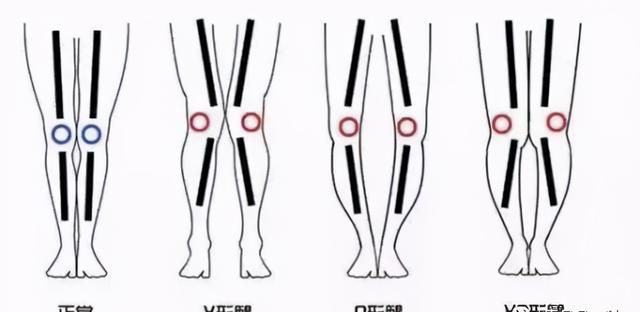 X型腿或者O型腿是不是越早矫正越好？绑腿能纠正O型腿吗？