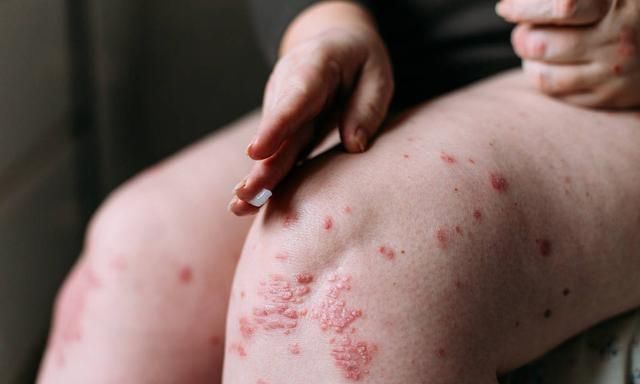 每日一味抗癌中药——黄柏，功效清热解毒、泻火燥湿，组方应用多