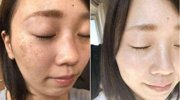 巧用红糖加“它”敷脸，美白淡斑还能去黑头，15天轻松恢复白净肌