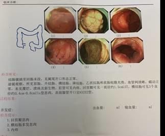 早期肠癌不痛不痒，医生提醒：出现6个异常，病情或已到中晚期