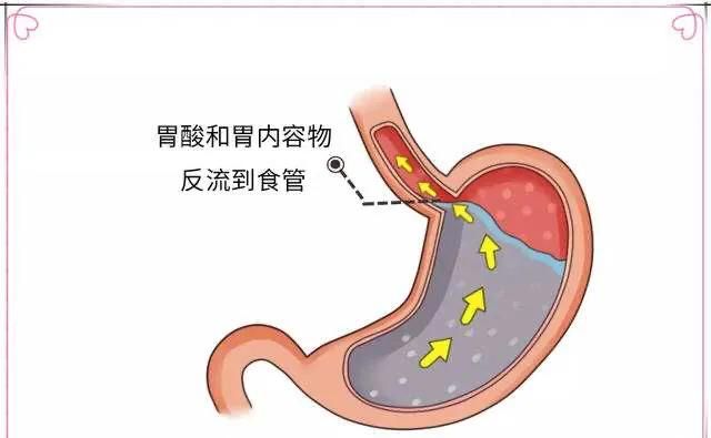 胃食管反流吃什么(胃食管反流吃什么中药能彻底治好)图1