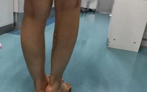 女子打瘦腿针右小腿短了(小腿打瘦腿针失败案例)