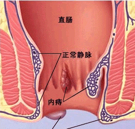 贾教授来科普：痔疮的分类与治疗，人人必须掌握的知识