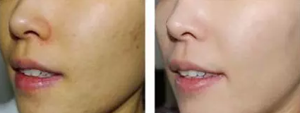 激光美白真的有用么？上周我去亲身体验了一次