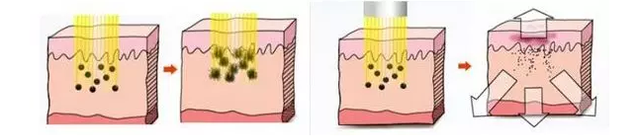 激光美白真的有用么？上周我去亲身体验了一次