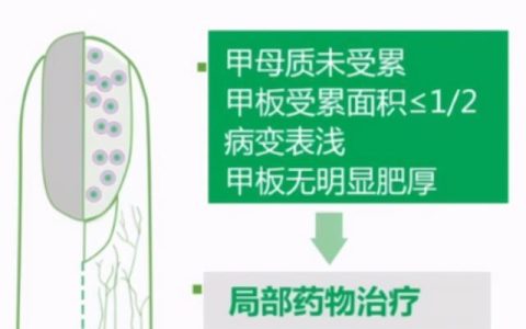 得了灰指甲很尴尬怎样才能治好它