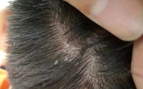 头皮银屑病反复怎么办,头皮银屑病好转6大征兆