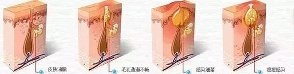 怎样安全有效祛除痘痕