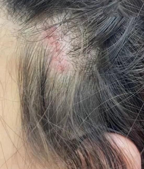 微创小切口面部提升，苹果肌下垂、法令纹明显的姐妹可以看看