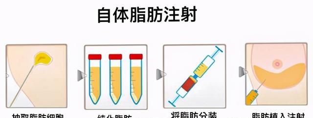 一次性说清“吸脂”，顶你做半年功课！（下）