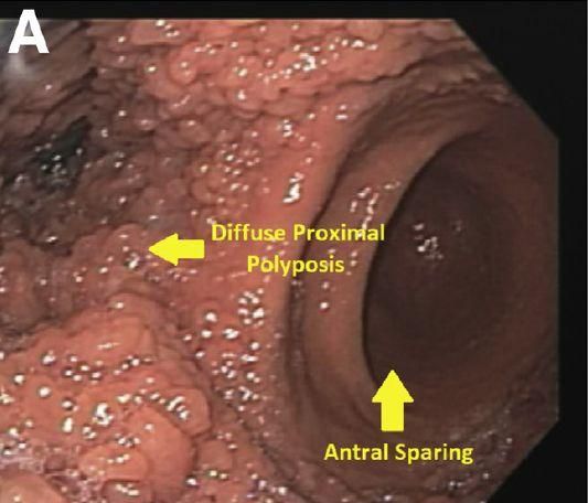 胃腺癌和胃近端息肉（GAPPS）：一种特殊的胃息肉病 | 病例学习